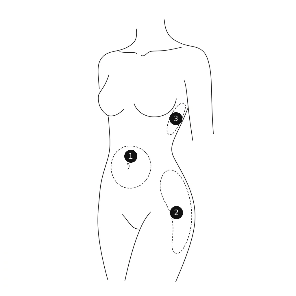 Ilustración de las zonas donde se aplica el láser para estrías: abdomen, caderas y muslos, senos y brazos